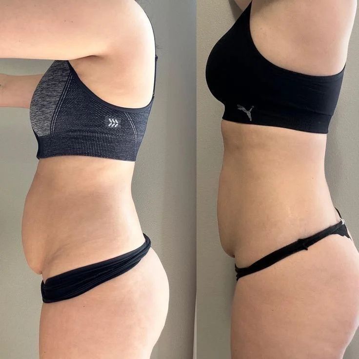 Antes y después - resultado